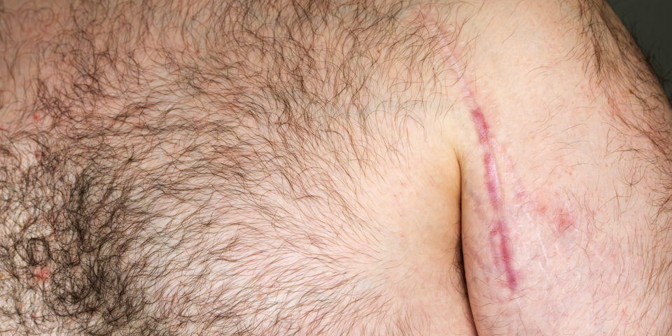 På billedet ses et nærbillede af et langt ar ved skulderen 