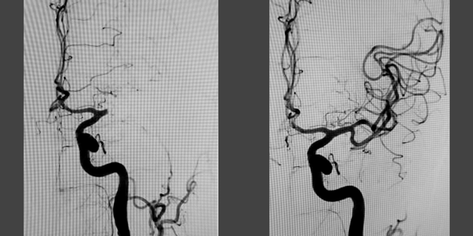Scanningsbilleder af hjerne, før og efter en blodproppen er blevet opløst.