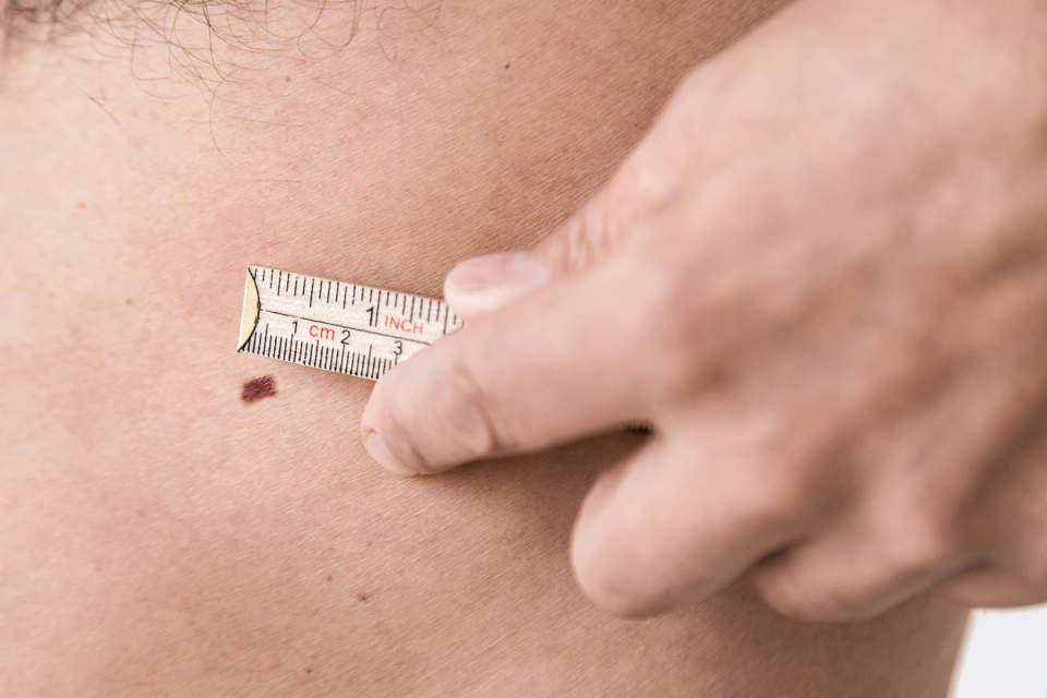 Mand måler modermærke med en tommestok