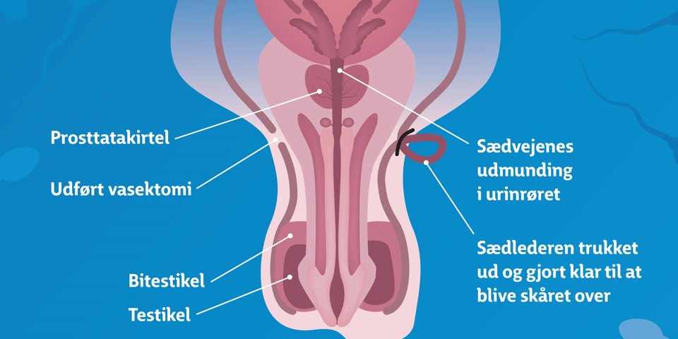 Grafik der viser, hvordan en såkaldt vasektomi, mandlig sterilisation, foregår.
