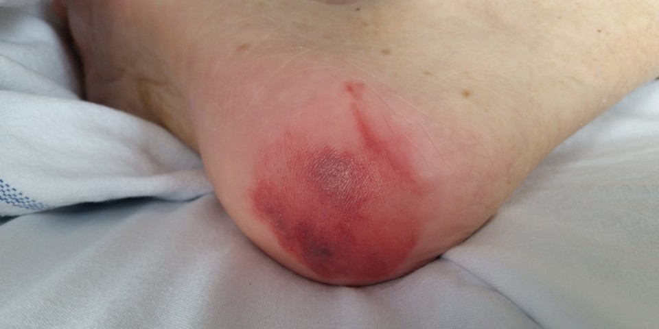 Billede af tryksår på hæl.